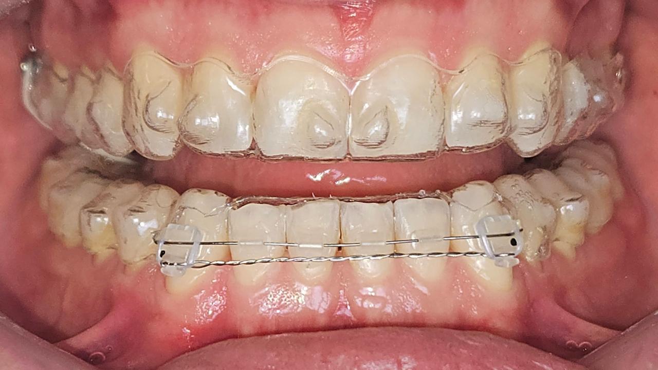 Registro intraoral frontal com alinhadores Invisalign
