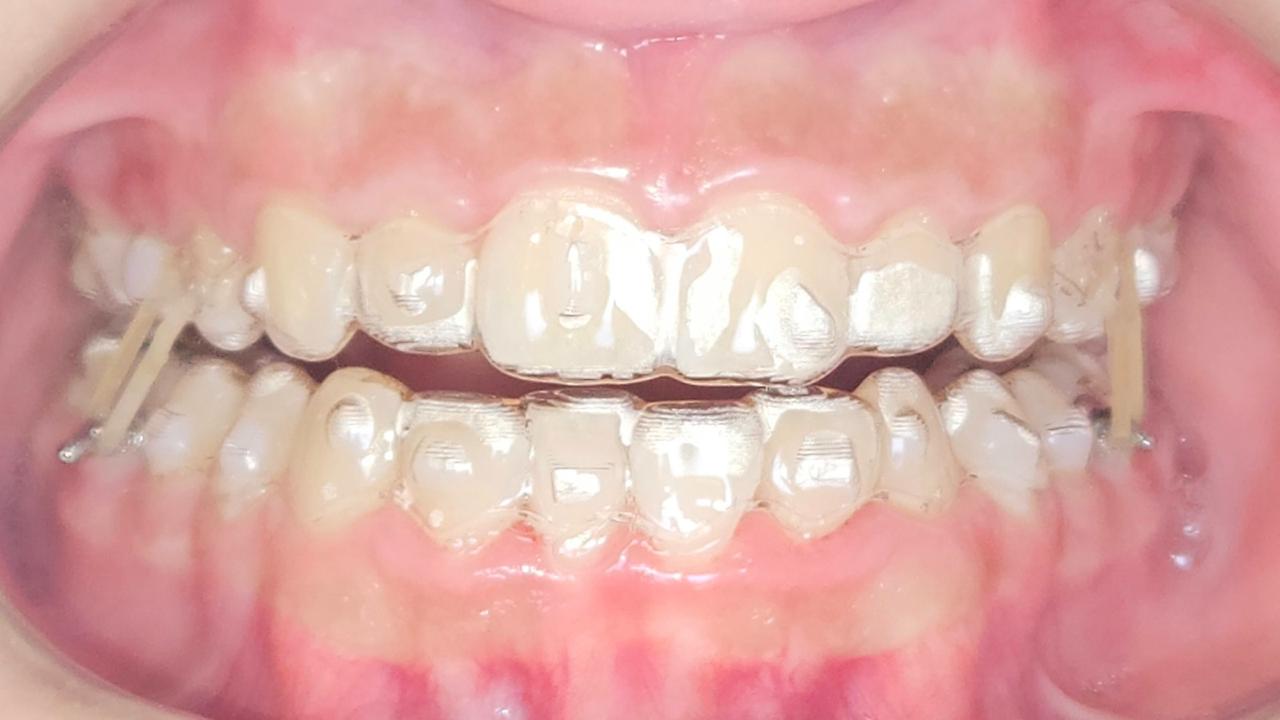 Registro intraoral frontal com alinhadores transparentes