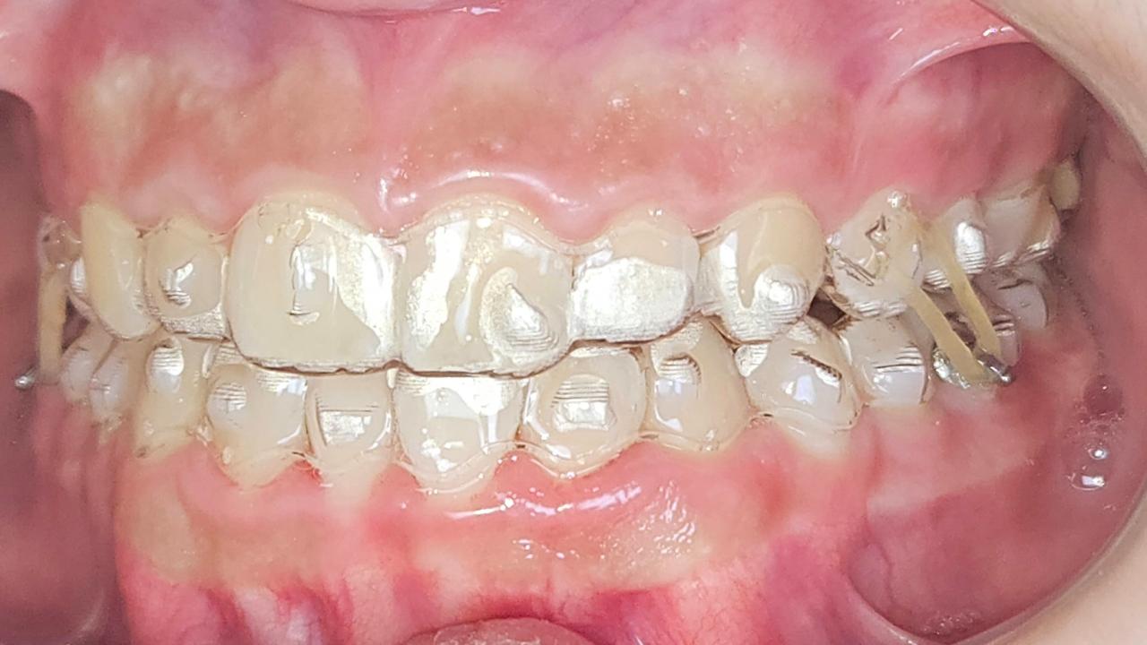Registro intraoral lateral com alinhadores transparentes